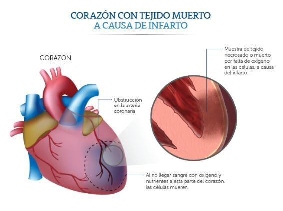 Tratamiento del infarto